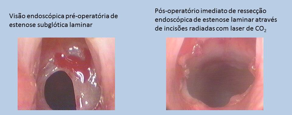 Cirurgia Estenose Laringotraqueal