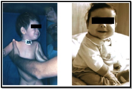 Traqueostomia na Criança